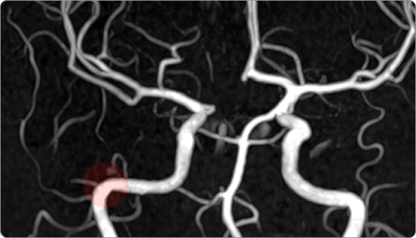 MRA 혈관 이미지