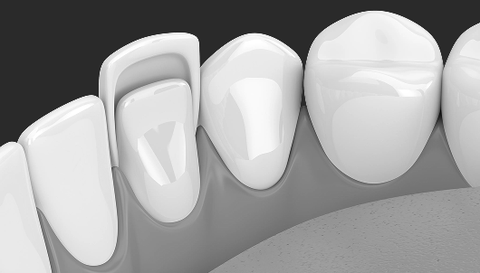 전치부 심미치료