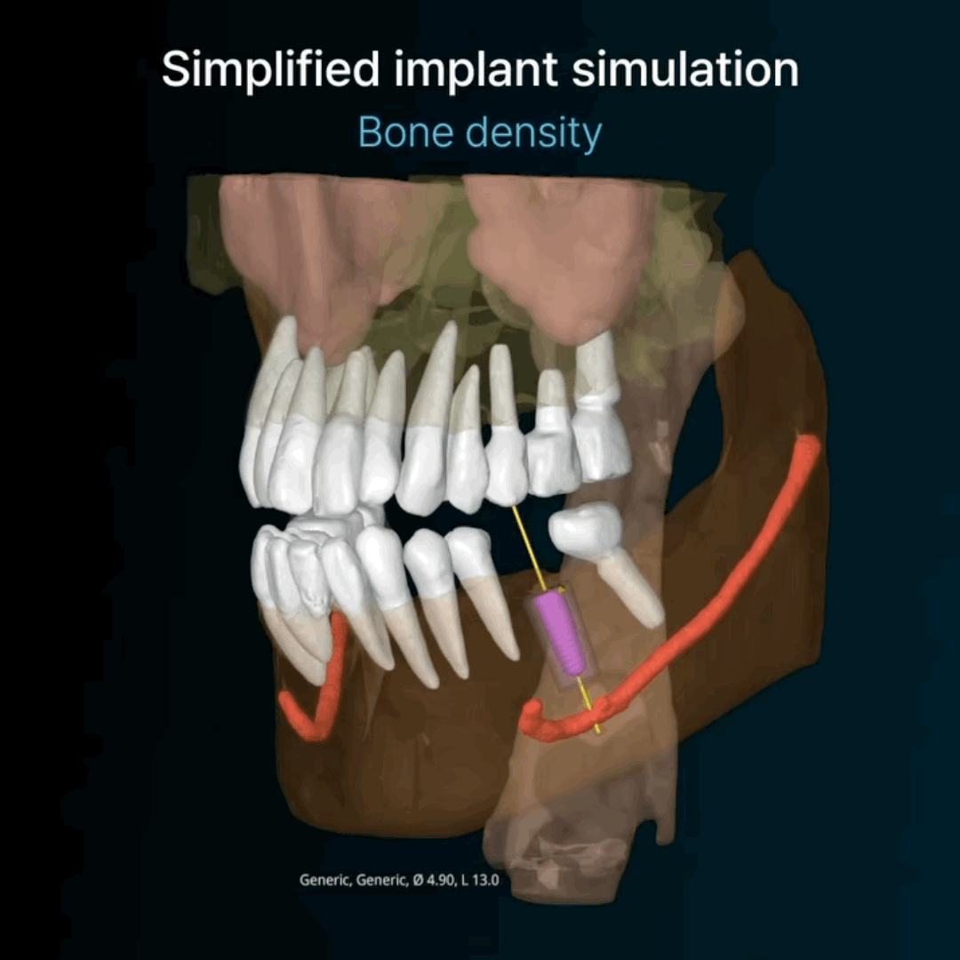 성베드로병원이 자랑하는 
평생 임플란트