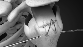 회전근개봉합술